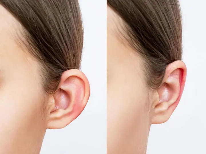 امکان برگشت گوش بعد از جراحی اتوپلاستی