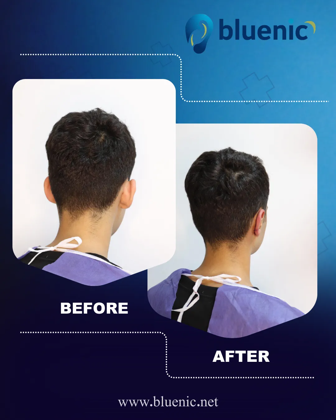 جراحی زیبایی گوش قبل از عمل و بعد از عمل