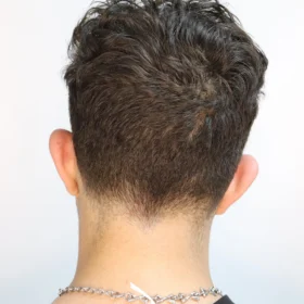 جراحی زیبایی گوش قبل از عمل