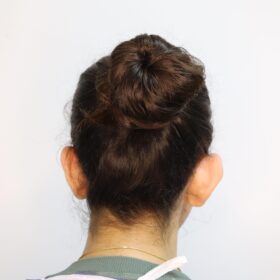 جراحی زیبایی گوش قبل از عمل 