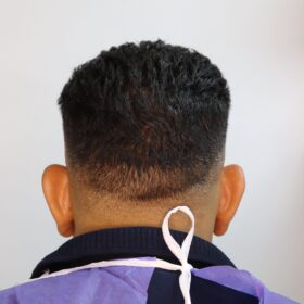 جراحی زیبایی گوش قبل از عمل 