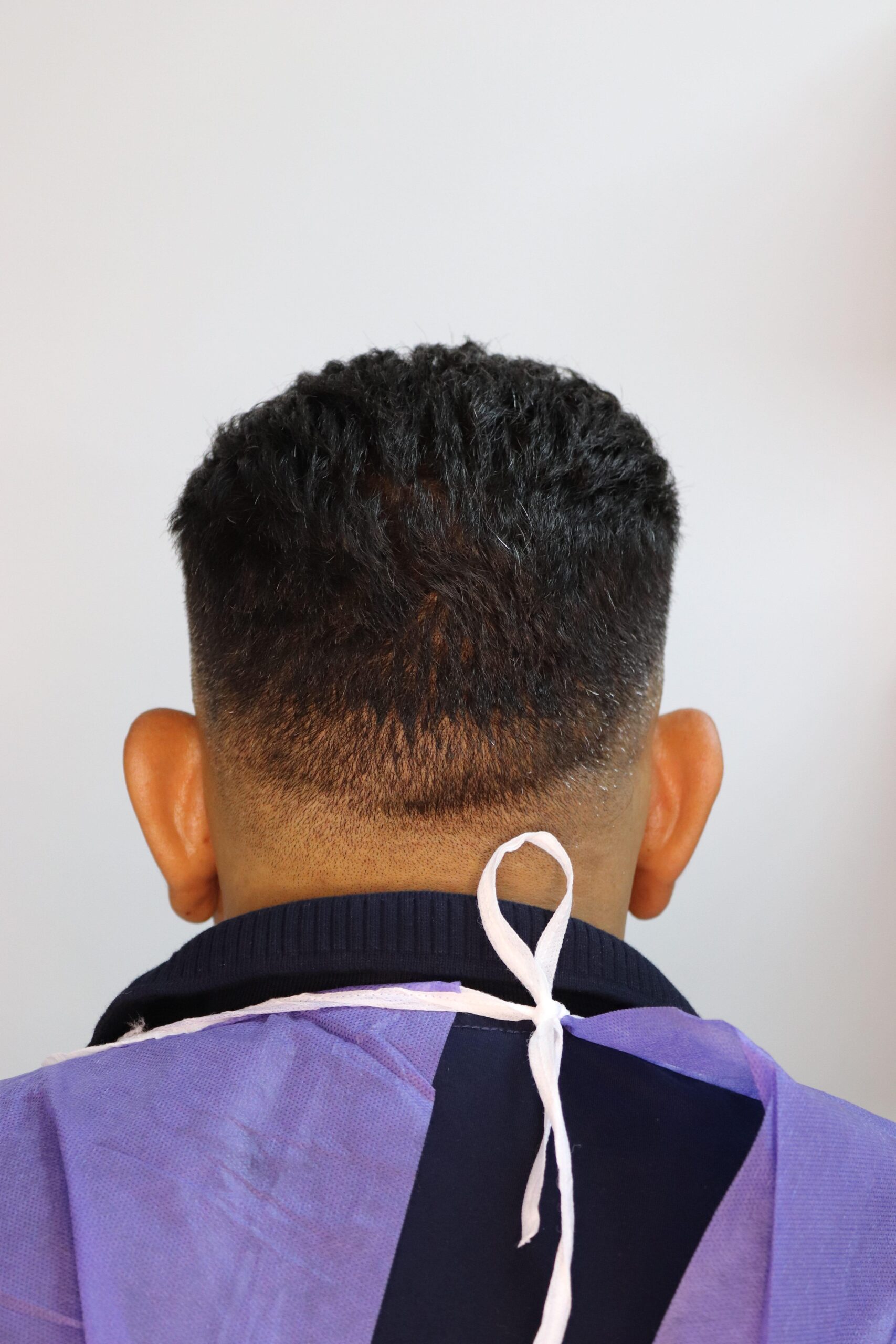 جراحی زیبایی گوش قبل از عمل