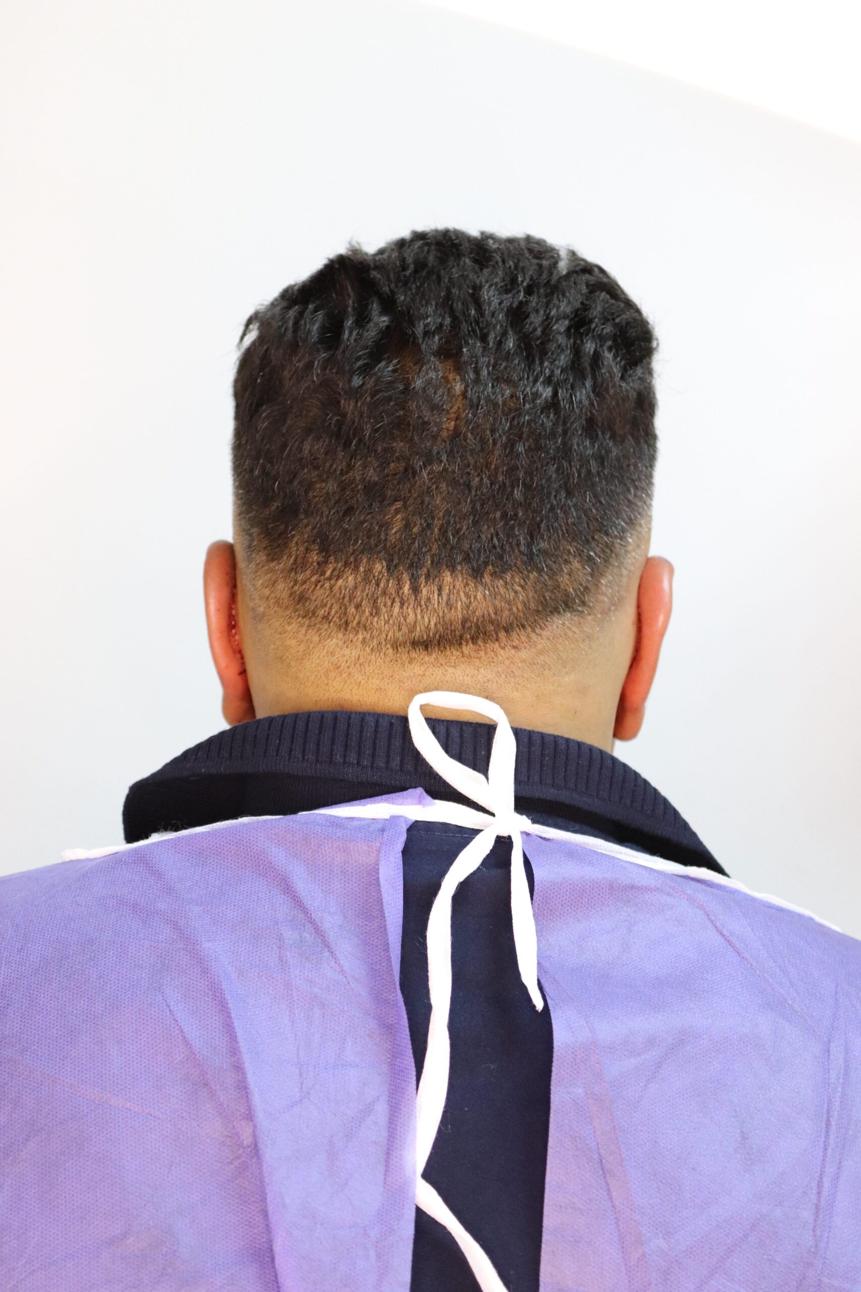 جراحی زیبایی گوش بعد از عمل