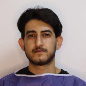 جراحی زیبایی گوش قبل از عمل 