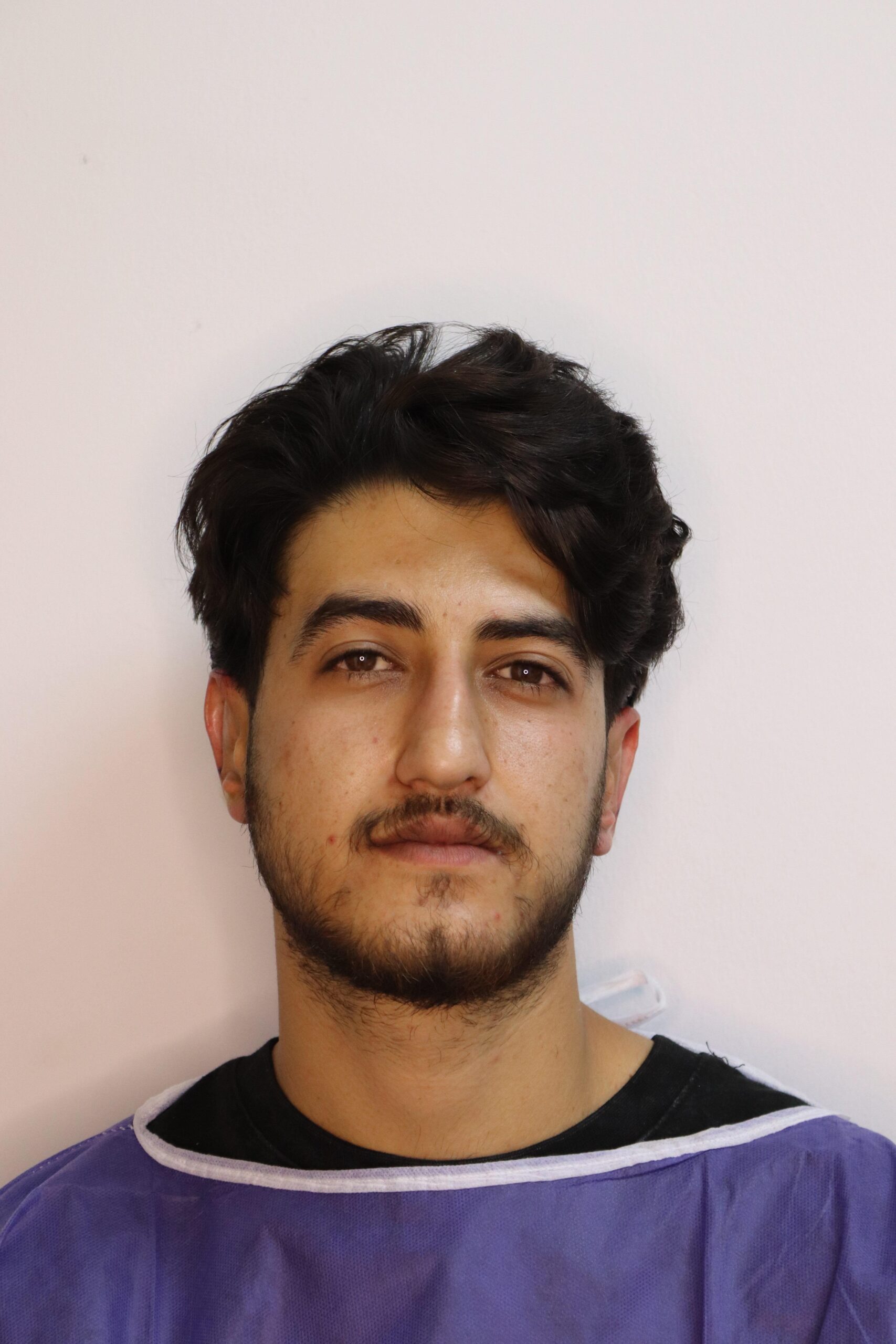 جراحی زیبایی گوش بعد از عمل