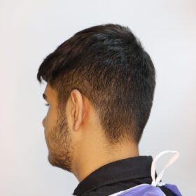 جراحی زیبایی گوش قبل از عمل 