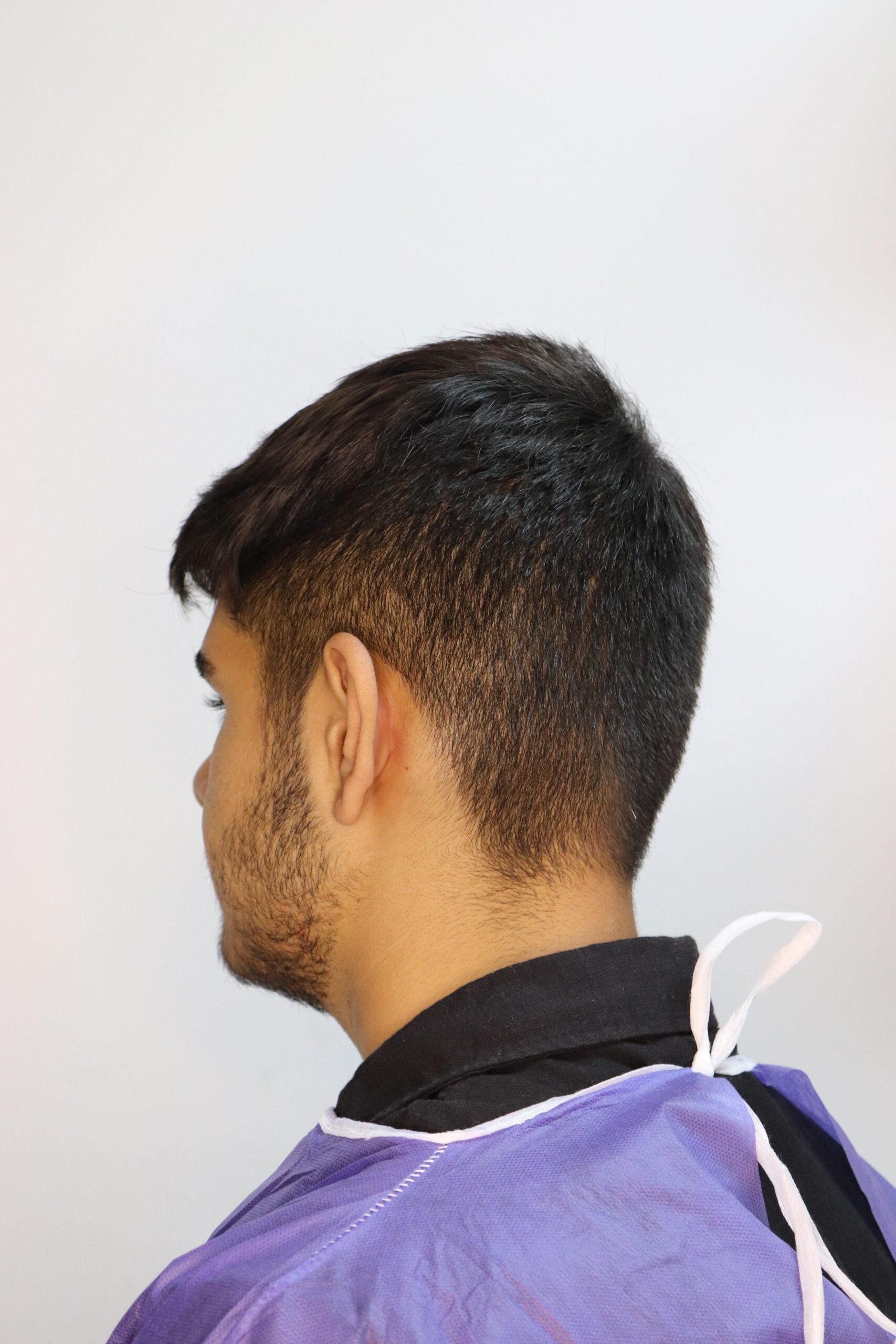 جراحی زیبایی گوش قبل از عمل