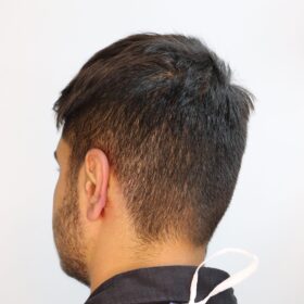 جراحی زیبایی گوش بعد از عمل 