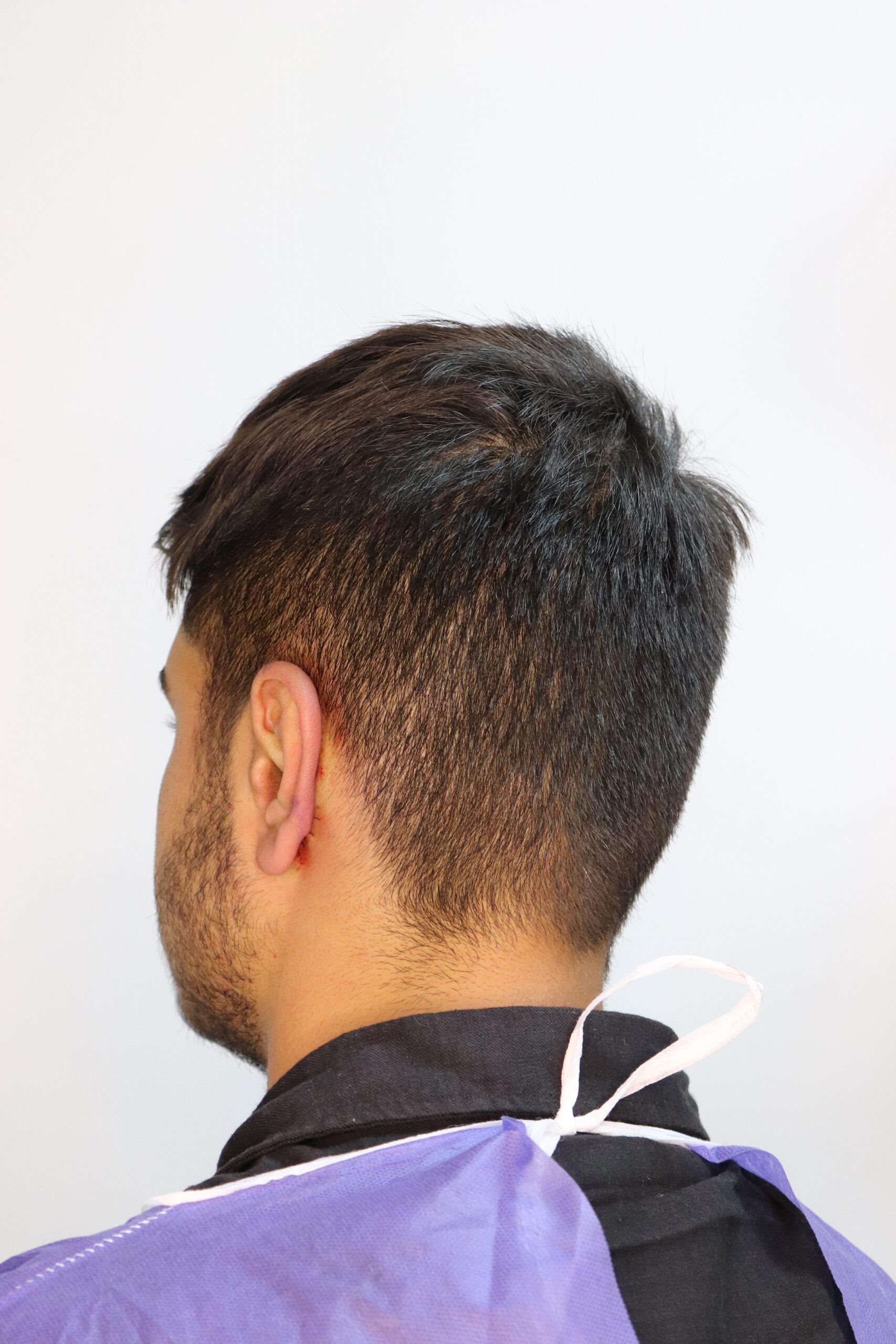 جراحی زیبایی گوش بعد از عمل