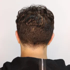 جراحی زیبایی گوش بعد از عمل