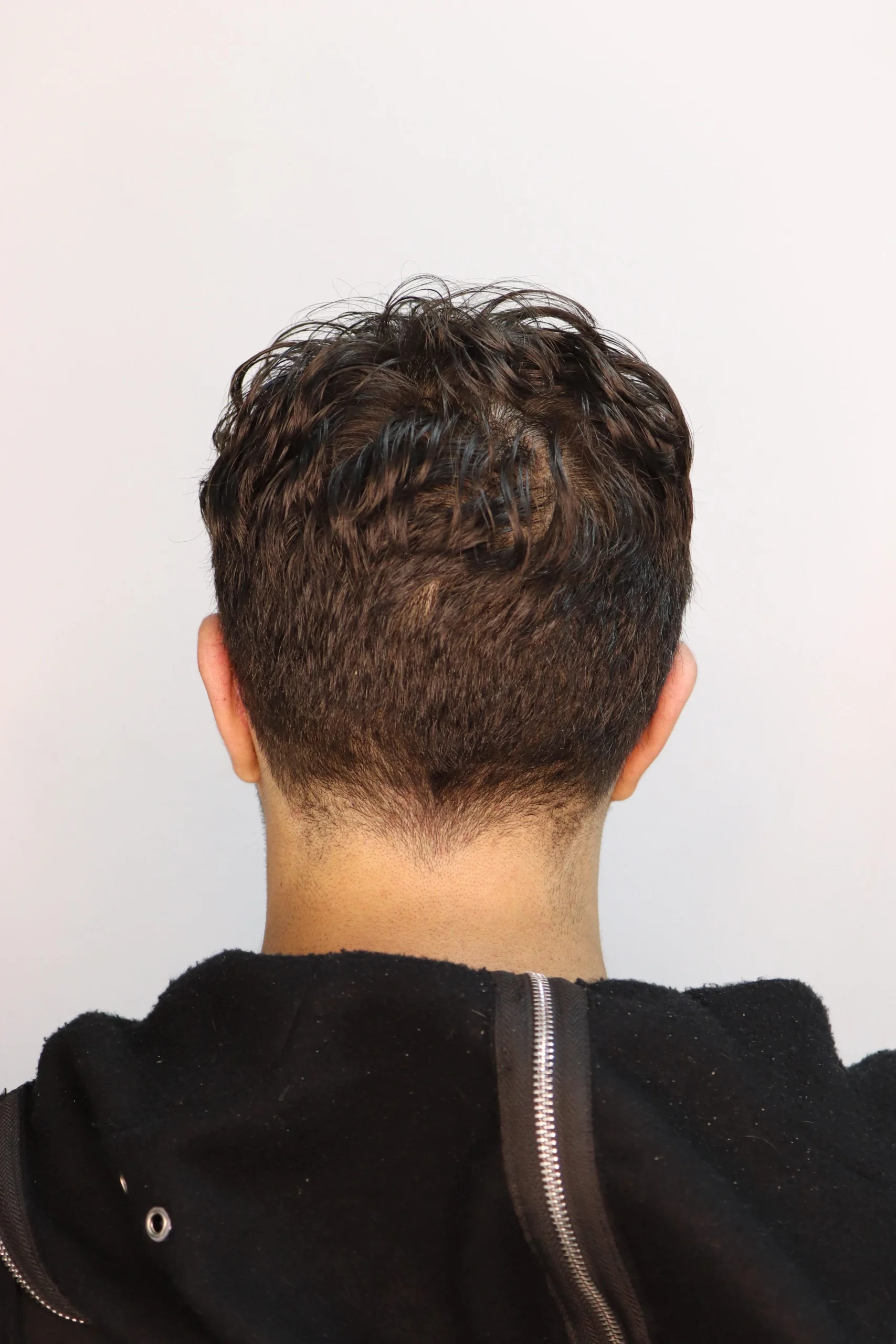 جراحی زیبایی گوش بعد از عمل