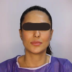 جراحی زیبایی گوش بعد از عمل