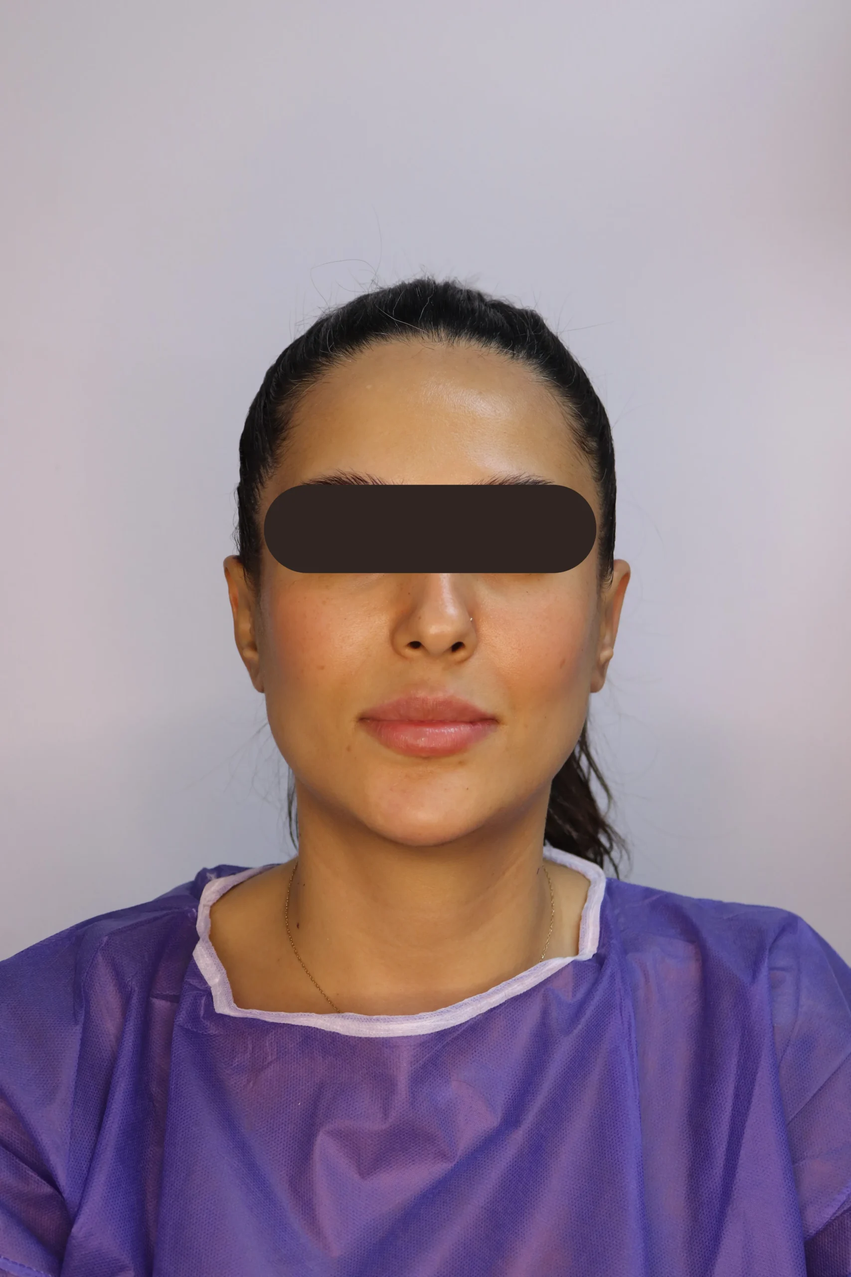 جراحی زیبایی گوش بعد از عمل