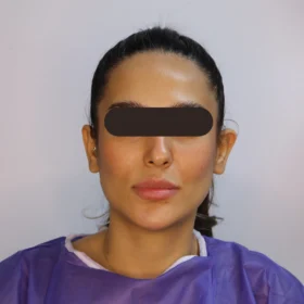 جراحی زیبایی گوش قبل از عمل